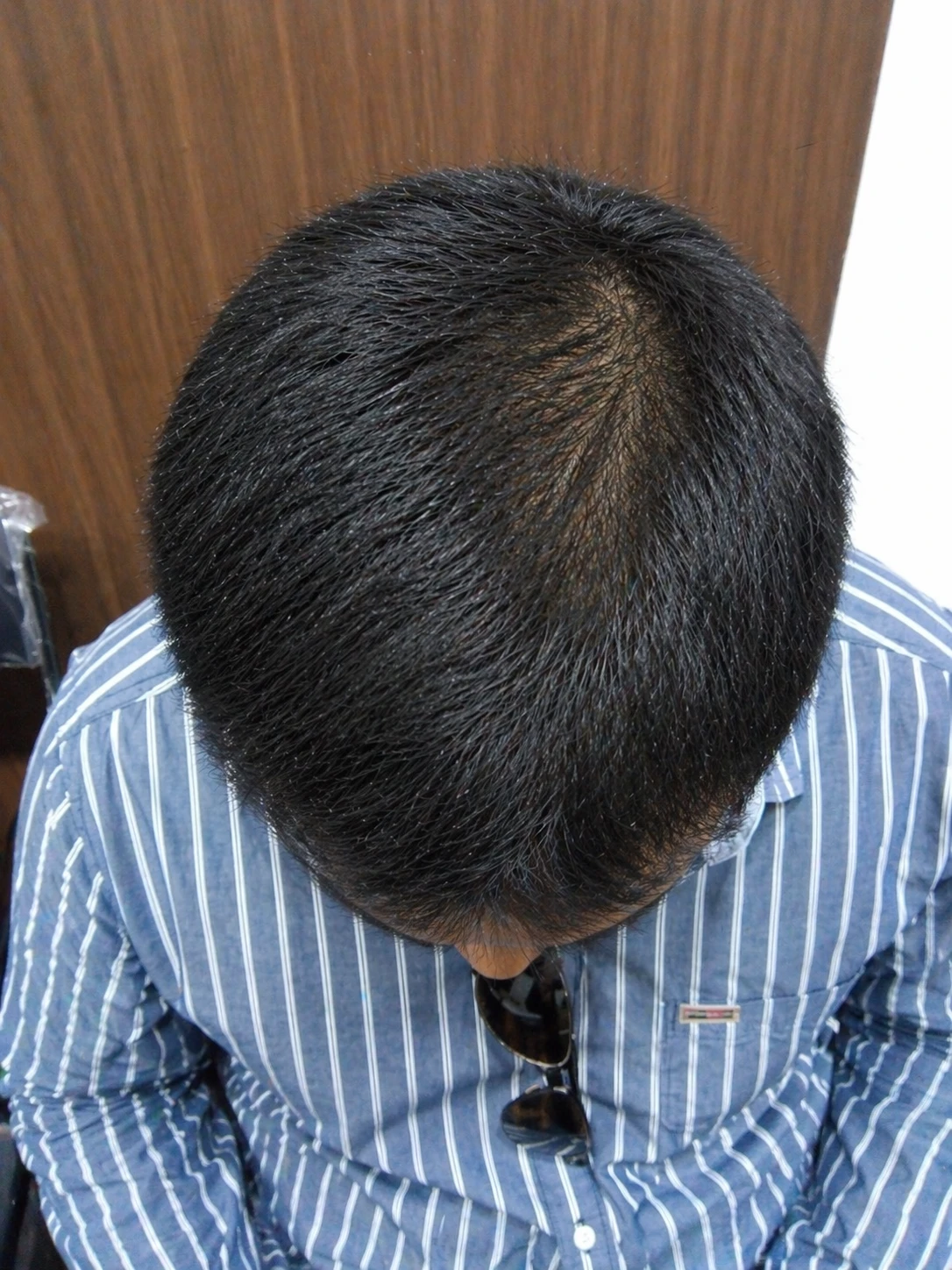After hair loss treatment