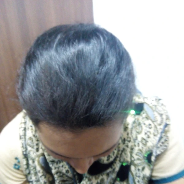 After alopecia treatment