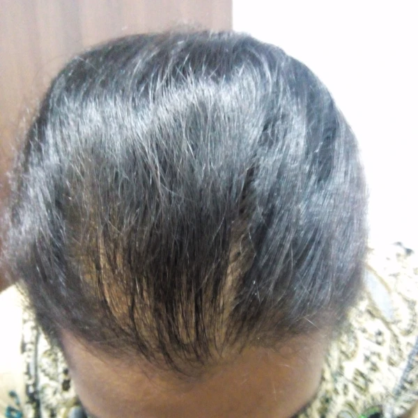 Before alopecia treatment